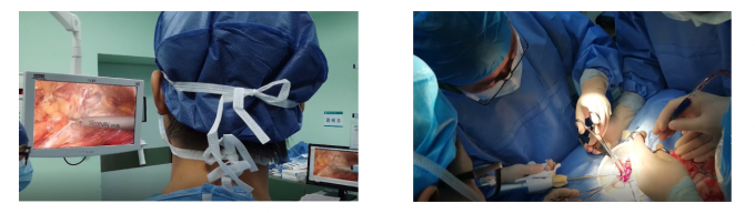 Aplicações Laparoscopic do escalpelo do sistema cirúrgico ultrassônico
